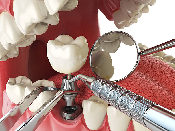 Best Emergency Treatment for Dental Infections or Abscesses in Doraville, GA